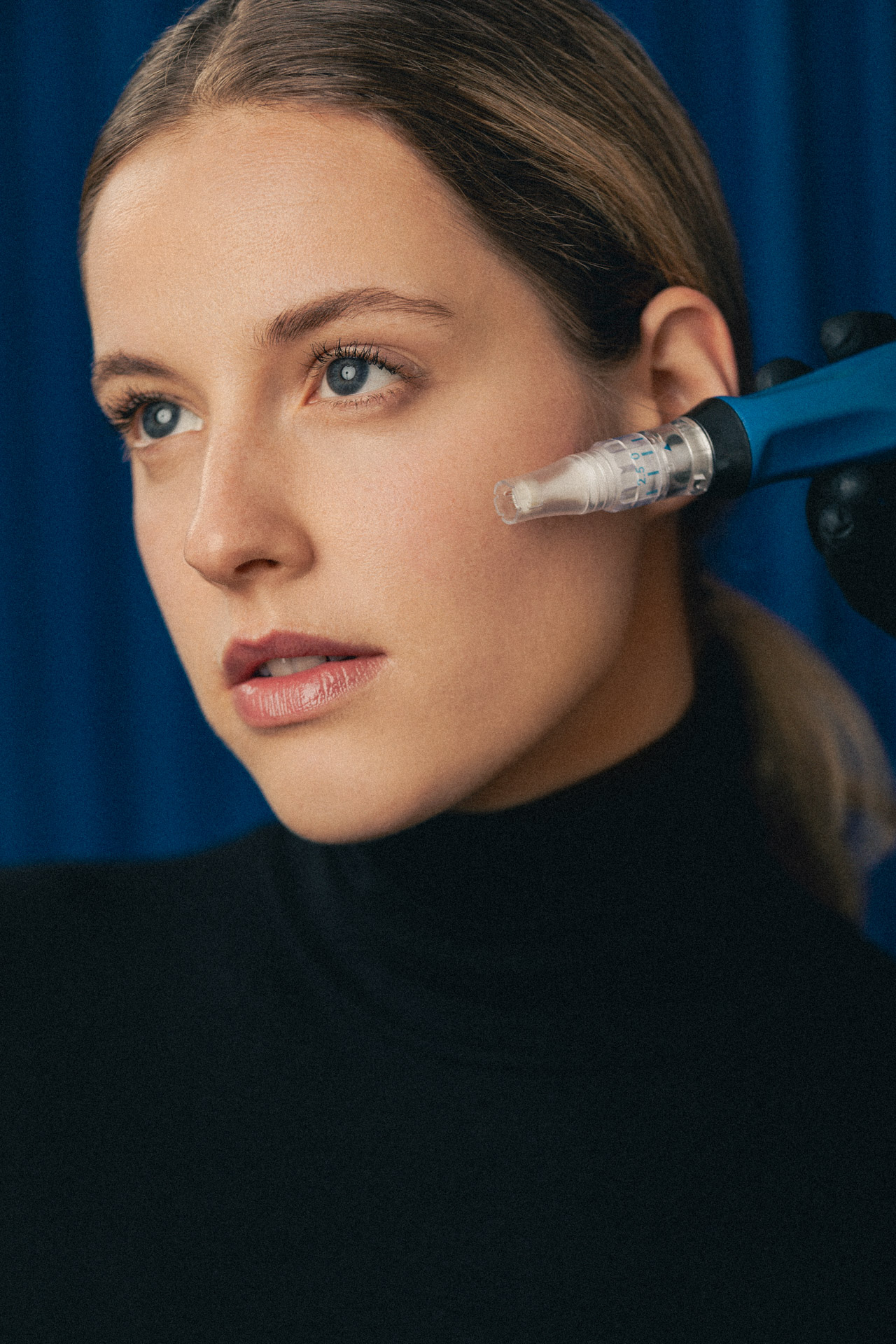 Portrait d'une jeune patiente recevant un traitement de microneedling sur la joue gauche par le Docteur Astier