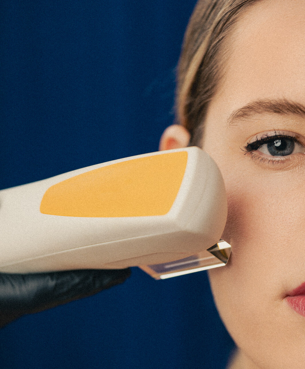 Portrait d'une jeune femme recevant un traitement par laser vasculaire et pigmentaire