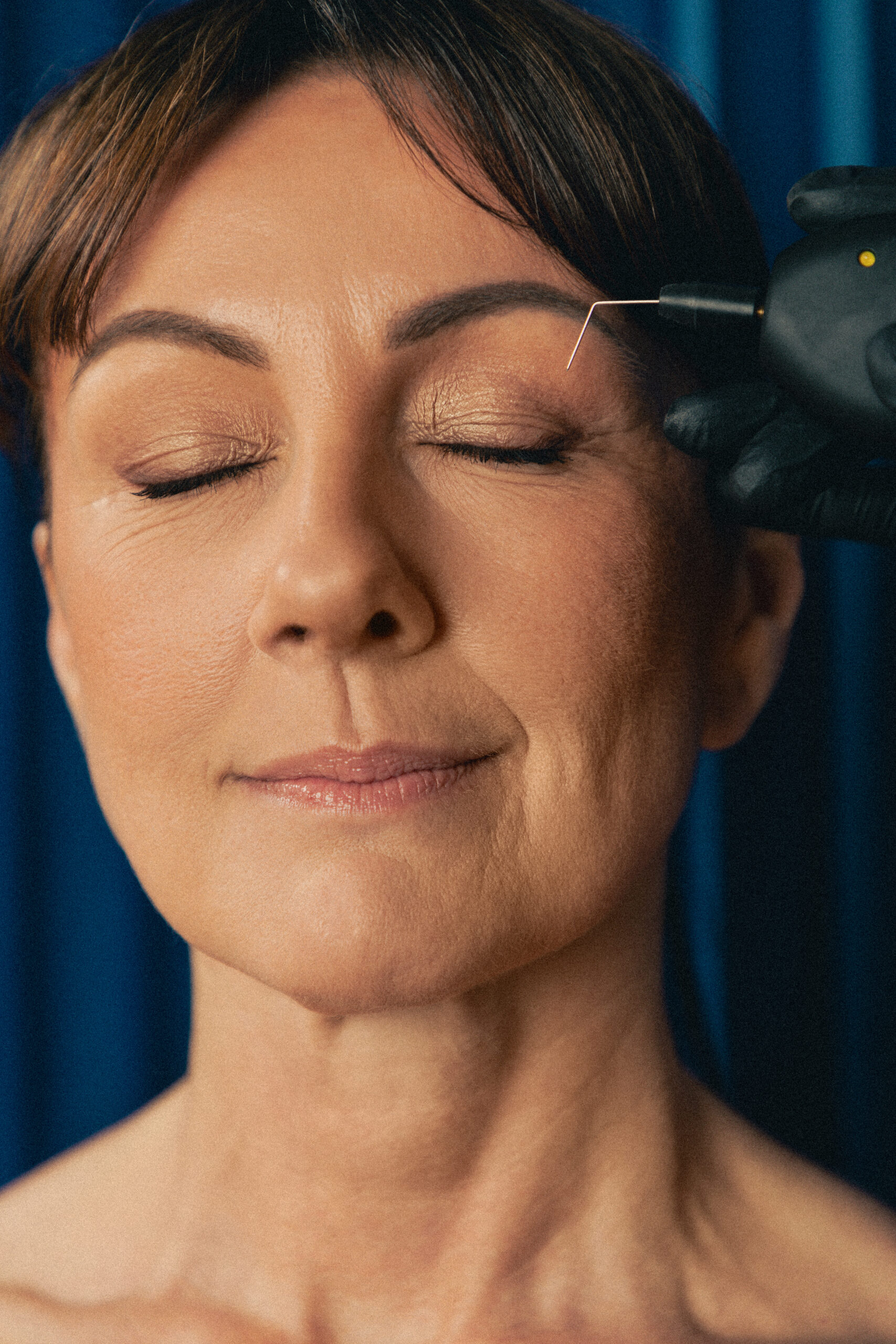 Portrait d'une femme de 45 ans recevant un traitement de blépharoplastie médicale par le Docteur Astier