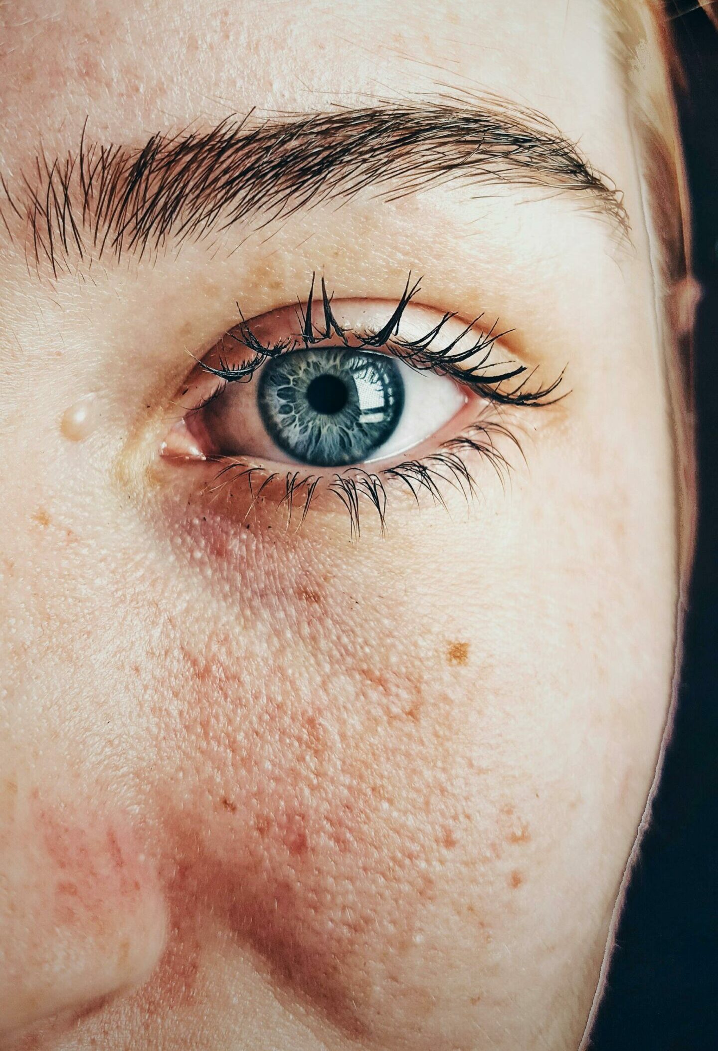 Photographie de la joue gauche d'une jeune femme ayant de la rosacée